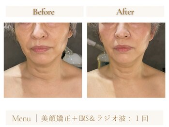 ムーア(muua)/美顔矯正×ラジオ波&EMS