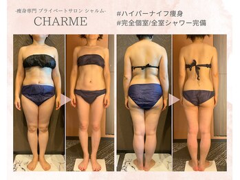 シャルム(charme)/ハイパーナイフ痩身/ダイエット
