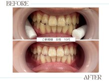 ホワイトニングサロンブライト 尼崎店(Whitening salon bright)/効果実感！