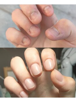 リリ(Rili)/深爪矯正