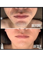 キビック(KIBIK)/【men's人気No.1 ヒゲ脱毛】