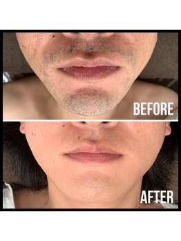 キビック(KIBIK)/【men's人気No.1 ヒゲ脱毛】