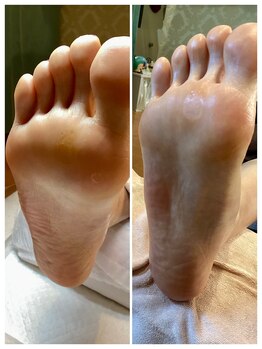 ドクターネイル爪革命 麻布十番店/【たこケア】フットケア