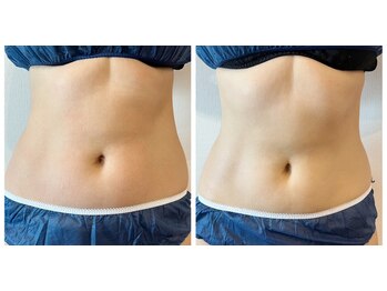 メディカルエース(MedicalAce)/痩身　看護師ハイサーマ　ボディ