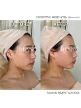サロン ド ブラン アオヤマ(Salon de BLANC AOYAMA)/くすみ改善&ニキビケア