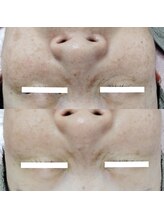 ビーユー(Be.you)/ピーリング×毛穴洗浄