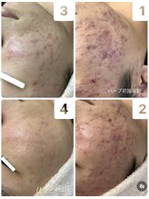 レア(Lea)/変化がわかるハーブピーリング