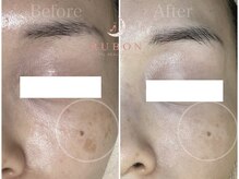 トータルビューティサロン ルボン(RUBON)/RUBONのシミ改善フェイシャル