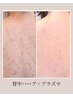 【背中】ハーブピーリング＋水光プラズマ◇背中トラブル徹底改善コース！！