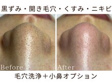 リリアン(lirien)/毛穴/毛穴ケア/毛穴洗浄/駒込