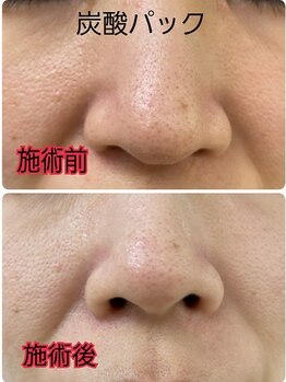 シェリー(Cheri)/【高濃度炭酸ジェルパック】