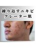 【メンズ専用】本格ニキビケア☆なめらか肌へ!90分12000円→