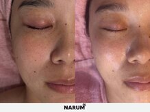 ナルムフェイシャル 代々木(NARUM facial)/白玉ピーリング/水光ピーリング