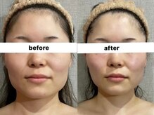 ウィズルーチェ 神栖店(with luce)/小顔5回効果★噛み締めエラ撲滅