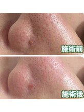 ルポ 那覇(repos)/ハイドロ毛穴洗浄