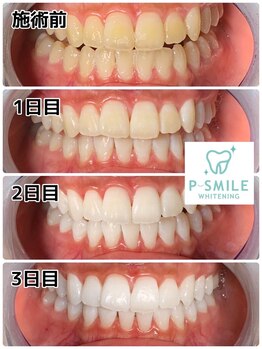 ホワイトベース(White Base)/before after