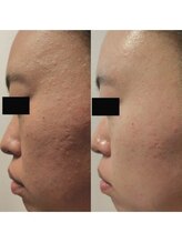 ホワイトアクア 姫路店(WHITE AQUA)/ララピール/姫路/美肌