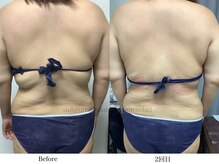 スラリ(SLARI)/【背中　脂肪冷却】期間1ヶ月