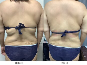 スラリ(SLARI)/【背中　脂肪冷却】期間1ヶ月