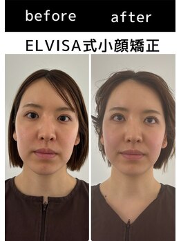 エレヴィザ トウキョウ 恵比寿院(ELVISA TOKYO)/ELVISA式小顔矯正 初回施術
