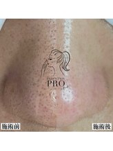 ピュール 鯖江店(PUR)/毛穴サロン/毛穴ケア/毛穴洗浄