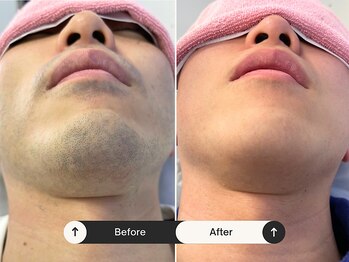 パッソ(Passo)/ブライダル前にビゲ脱毛