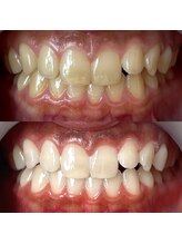 ワールドビューティー(World Beauty)/20代女性/ホワイトニング　6回