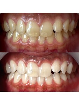 ワールドビューティー(World Beauty)/20代女性/ホワイトニング　6回