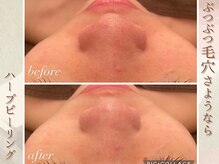 ラナ(LaNa)/鼻の黒ずみも綺麗に