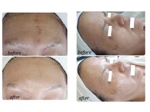 エアリアル 八女店/人気のハーブピーリング！