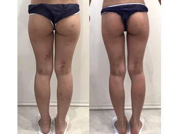 リラパドマ 千葉店(Rela Padma)/激痩せ短期集中ダイエットコース