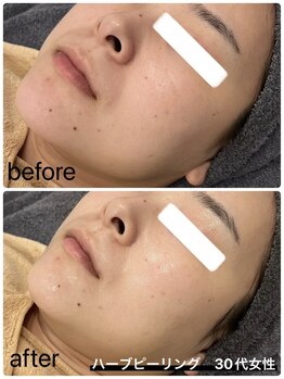 イル 名取店(iru)/剥離なし！国産ハーブピーリング