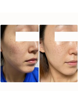 アルバ 広島店(ALBA)の写真/気になるしみシワを解決し年齢によるたるみに寄り添うケアで自信あふれる肌へ♪