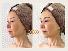 ココポキ 岐阜店/ツヤ玉水光フェイシャル　一回