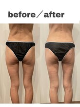 長寿鍼灸院 長寿整骨院/EMS＜ヒップUP集中コース＞