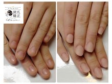 トイロ(toiro)/症例数50000件以上☆