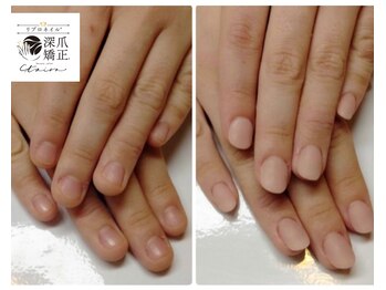 トイロ(toiro)/症例数50000件以上☆