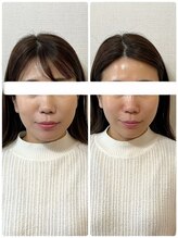 メディカルエース(MedicalAce)/【最強引き上げ】ハイサーマ