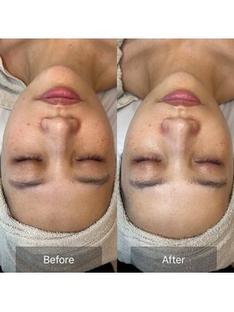 プライベートエステティックサロン アメジスト(AMETHYST)/ララピールbeforeAfter　９