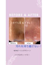 レガート(Legato)/毛穴洗浄ピーリング黒ずみ解消♪