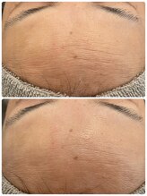 トリアングル(TLIENGLE)/ララピール　before　after