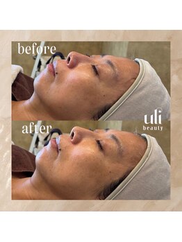 ウリ(uli beauty)/比較写真