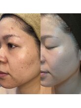 エラ(ella)/30代　ニキビ・色素沈着