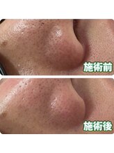 ルポ 那覇(repos)/ハイドロ毛穴洗浄