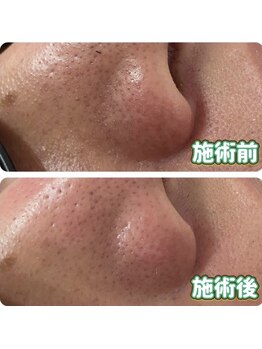 ルポ 那覇(repos)/ハイドロ毛穴洗浄