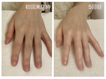 キレイテ 上野店/40代/5回目【ハンドケア上野】