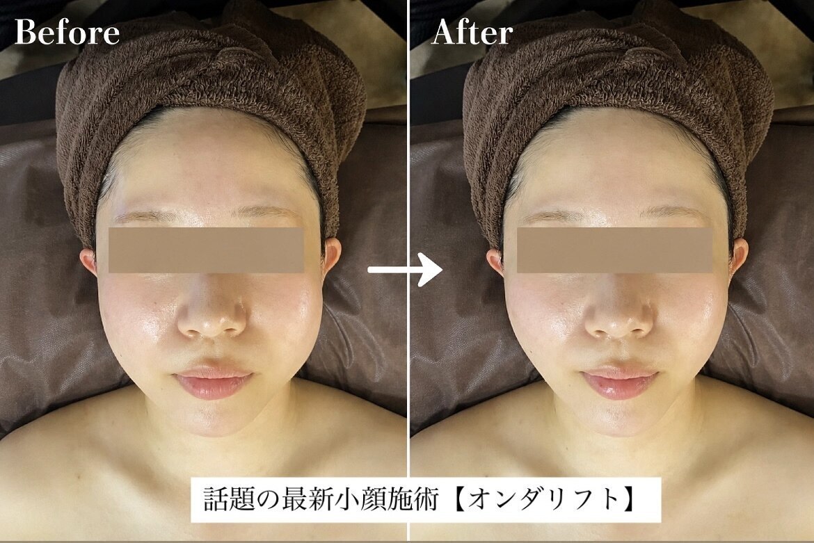 値下げ☆彡SITERA シテラ 高級美顔 ほぼ未使用 小顔ケア・リフトアップ