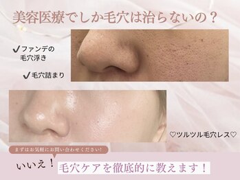 ムーンサン(Moon sun)の写真/毛穴の開き・黒ずみ・ザラつきの原因を徹底除去し、ツヤのあるお肌に!肌質別お仕上げジェルパック付き*