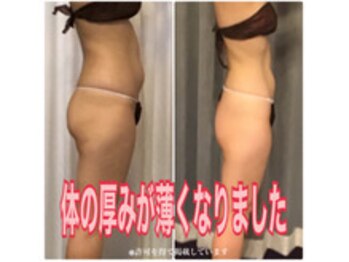 ボディエステティック アクアオーラ 富山店/お腹スッキリ！