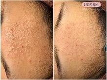 レスイズモア 恵比寿(less is more.)/毛穴詰まり1回の変化